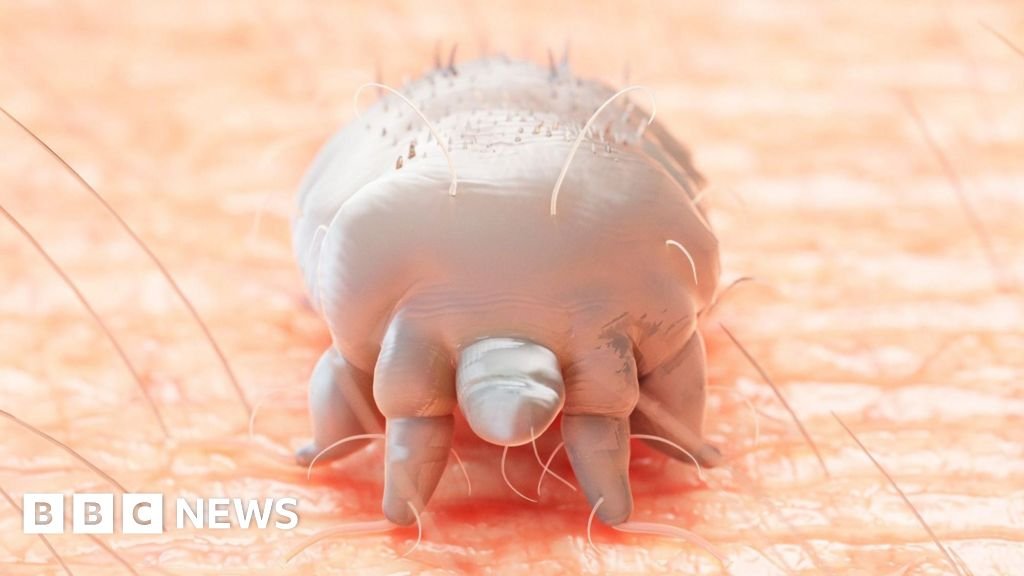 Mum's scabies 'nightmare' as reports of parasitic infestations rise
